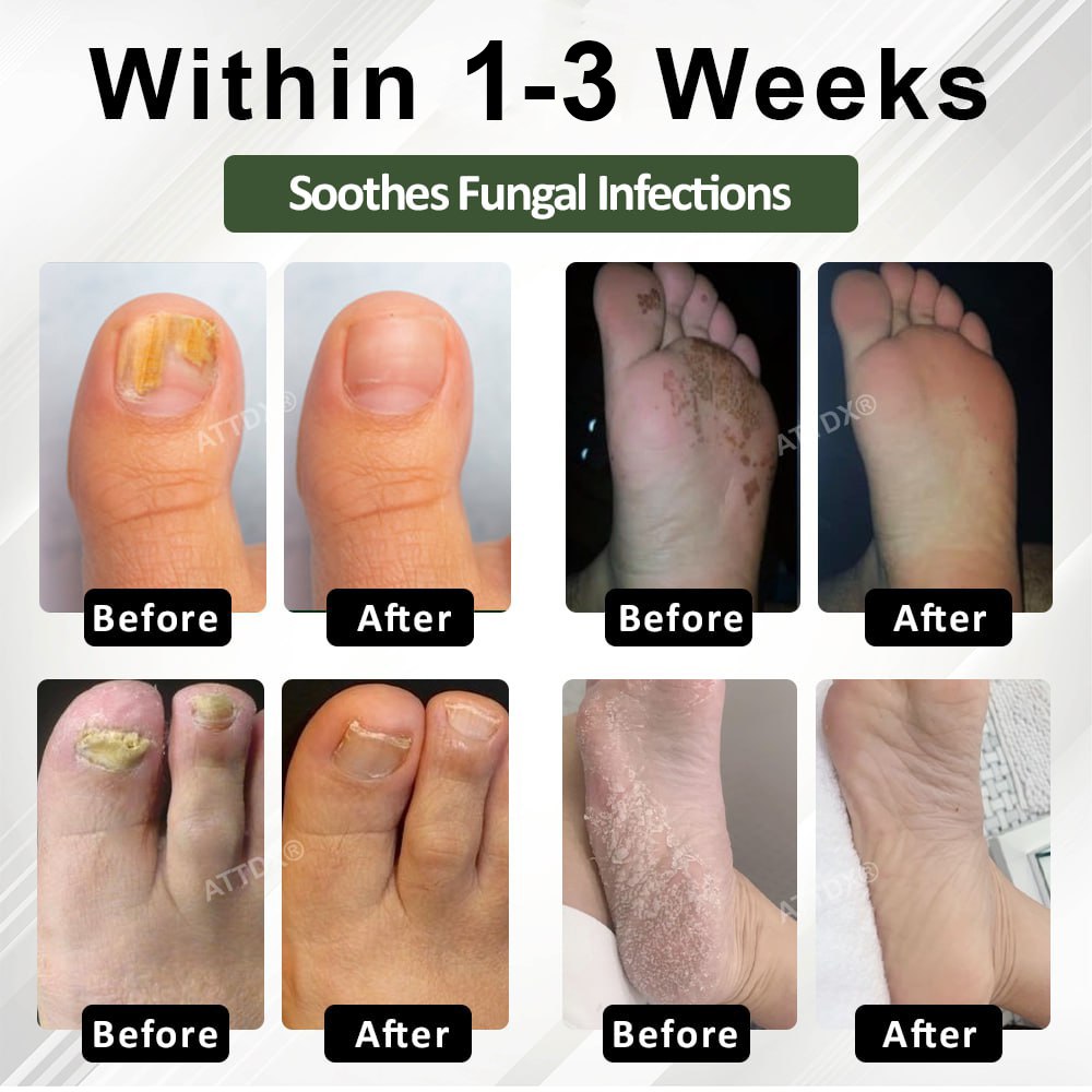 Cvreoz® 7 days Nail Fungus Renewal Herbal Spray🎁🎁