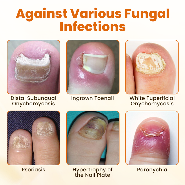 🧡 CVREOZ® FungiFix Bee Venom Nail Spray 🐝✨