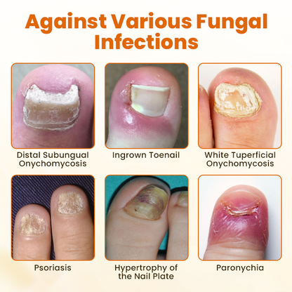 🧡 CVREOZ® FungiFix Bee Venom Nail Spray 🐝✨