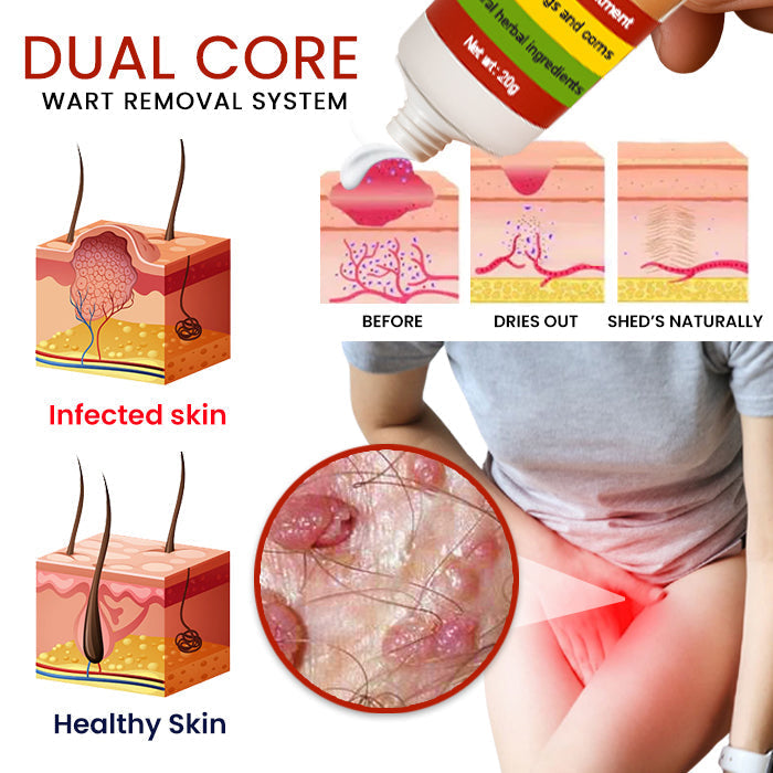 💥 2025 Limited OFFER 60% OFF ️⏳ Cvreoz® FemGenital Wart Remover Cream