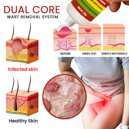 💥 2025 Limited OFFER 60% OFF ️⏳ Cvreoz® FemGenital Wart Remover Cream