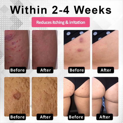 🔥 Special Deal: 60% OFF 🌸 CVREOZ® Woman's Genital HPV Healing Cream 🌸
