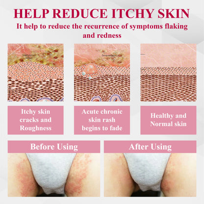 🔥 Special Deal: 60% OFF 🌸 CVREOZ® Woman's Genital HPV Healing Cream 🌸