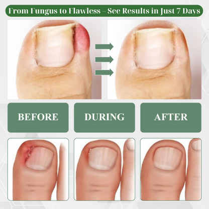 Cvreoz®  7 days Nail Fungus Renewal Herbal Spray🎁🎁