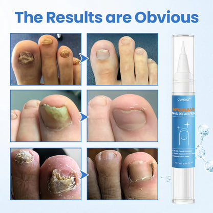 💅🏻 CVREOZ® MycoClear Nail Repair Pen 🖋️ Hot Sale Up To 60% 🔥