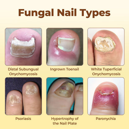 CVREOZ® Bee Venom Nail Fungus Care Spray