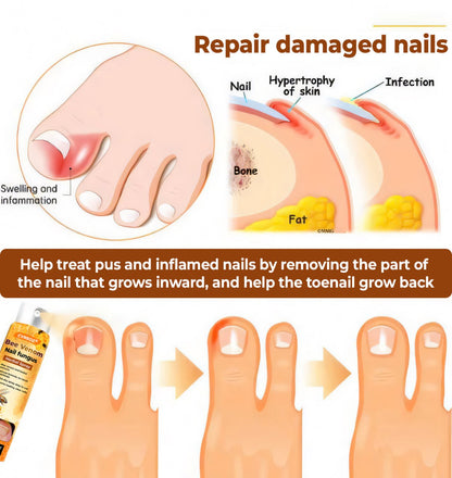 💥 2025 Limited 60% OFF ️⏳ Crveoz® Bee Venom Nail Fungus Herbal Spray