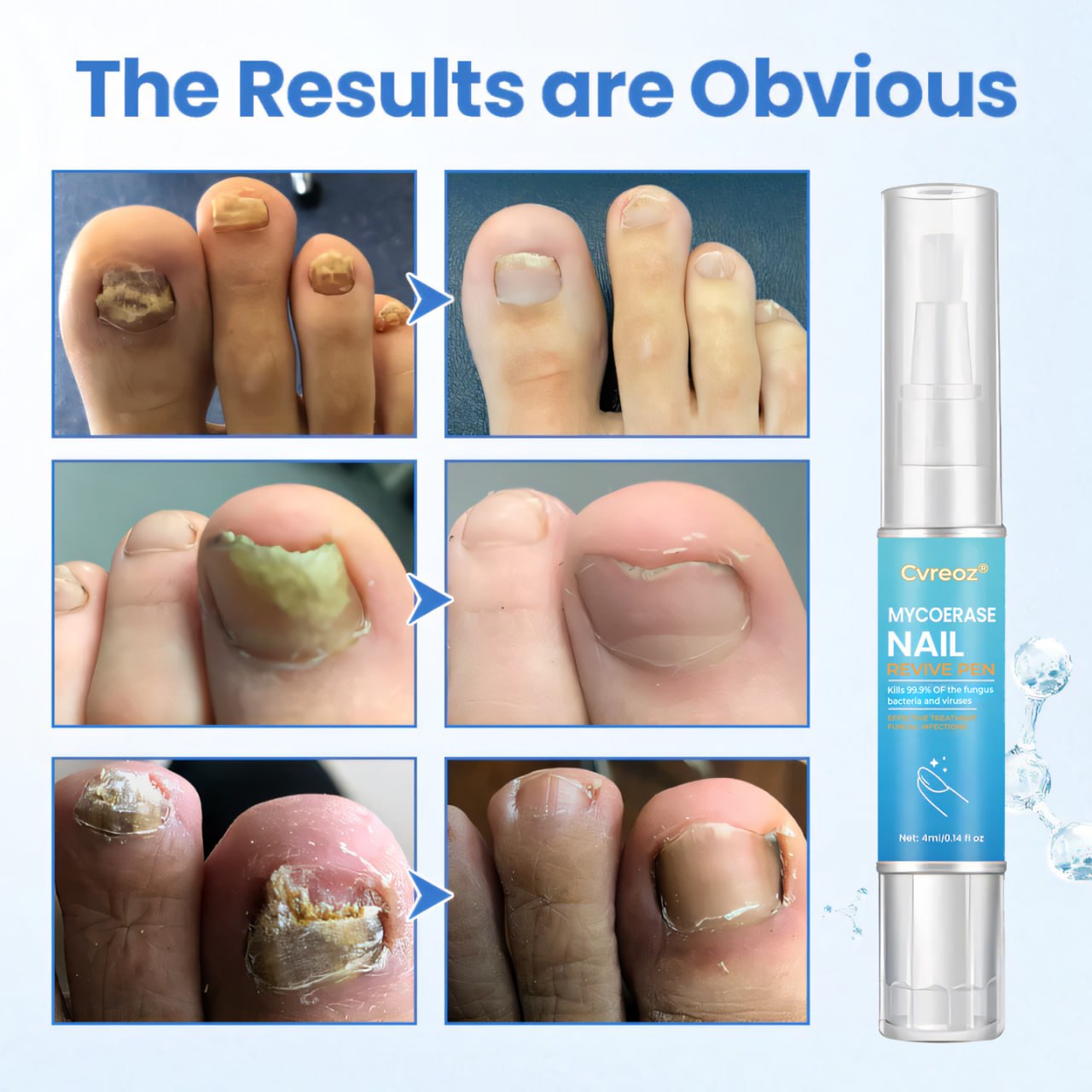 Cvreoz® MycoErase Nail Revive Pen⭐